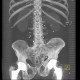 Unknown pathology, foreign bodies in peritoneal cavity: CT - Computed tomography